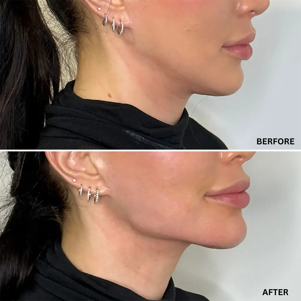 Intense Pulsed Light®